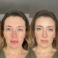 New Skin Society before and after result
