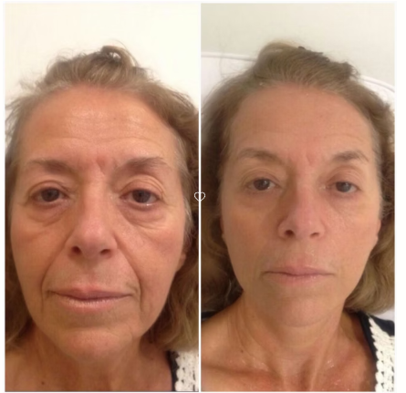 New Skin Society before and after result